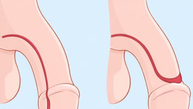 Epispádia: o que é e quando precisa de tratamento?